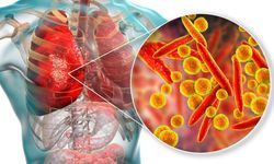 Uzmanı Uyardı: "Hafife Alınan Zatürre Ölümünüze Neden Olabilir"