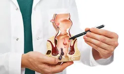 Hemoroid'e Kesi ve Dikişsiz Lazerli Tedavi