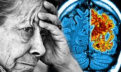 Uzmanı Alzheimer'a Karşı Uyardı