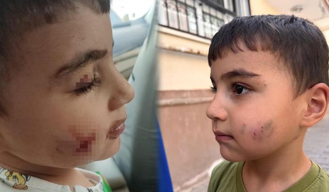 Evde Uyuyan Çocuğu Lağım Faresi Isırdı