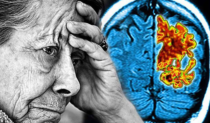 Uzmanı Alzheimer'a Karşı Uyardı